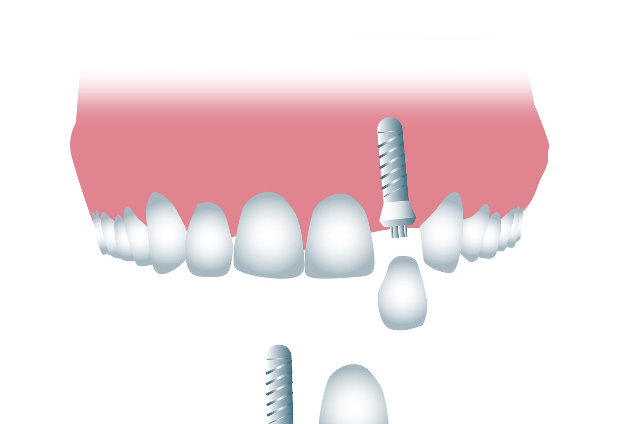 种植牙，重塑微笑的秘密利器