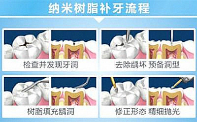 玻璃离子水门汀填充的注意事项详解